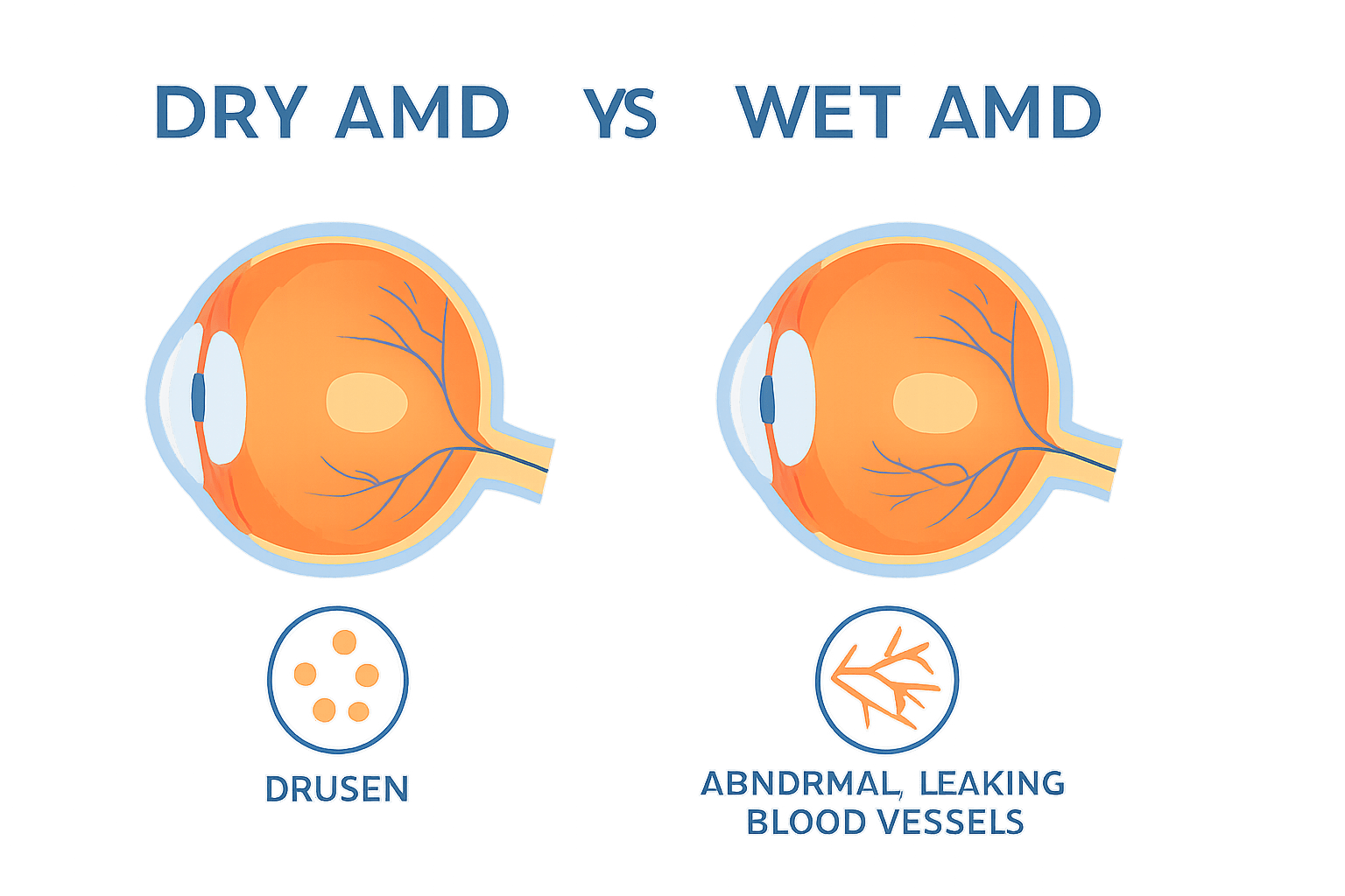 What's the difference between Dry and Wet Macular Degeneration