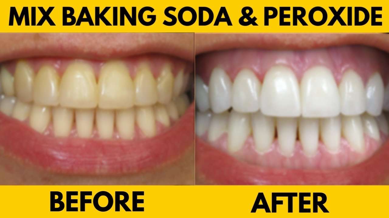 Baking soda and hydrogen peroxide, How can I remove hardened tartar from my teeth at home?