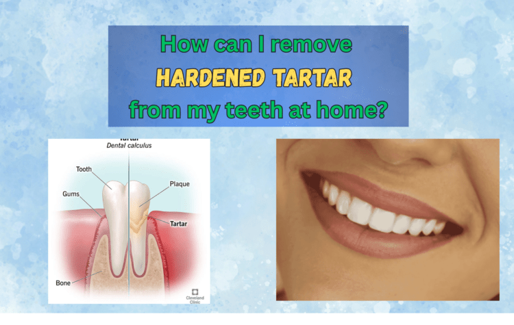 How can I remove hardened tartar from my teeth at home?