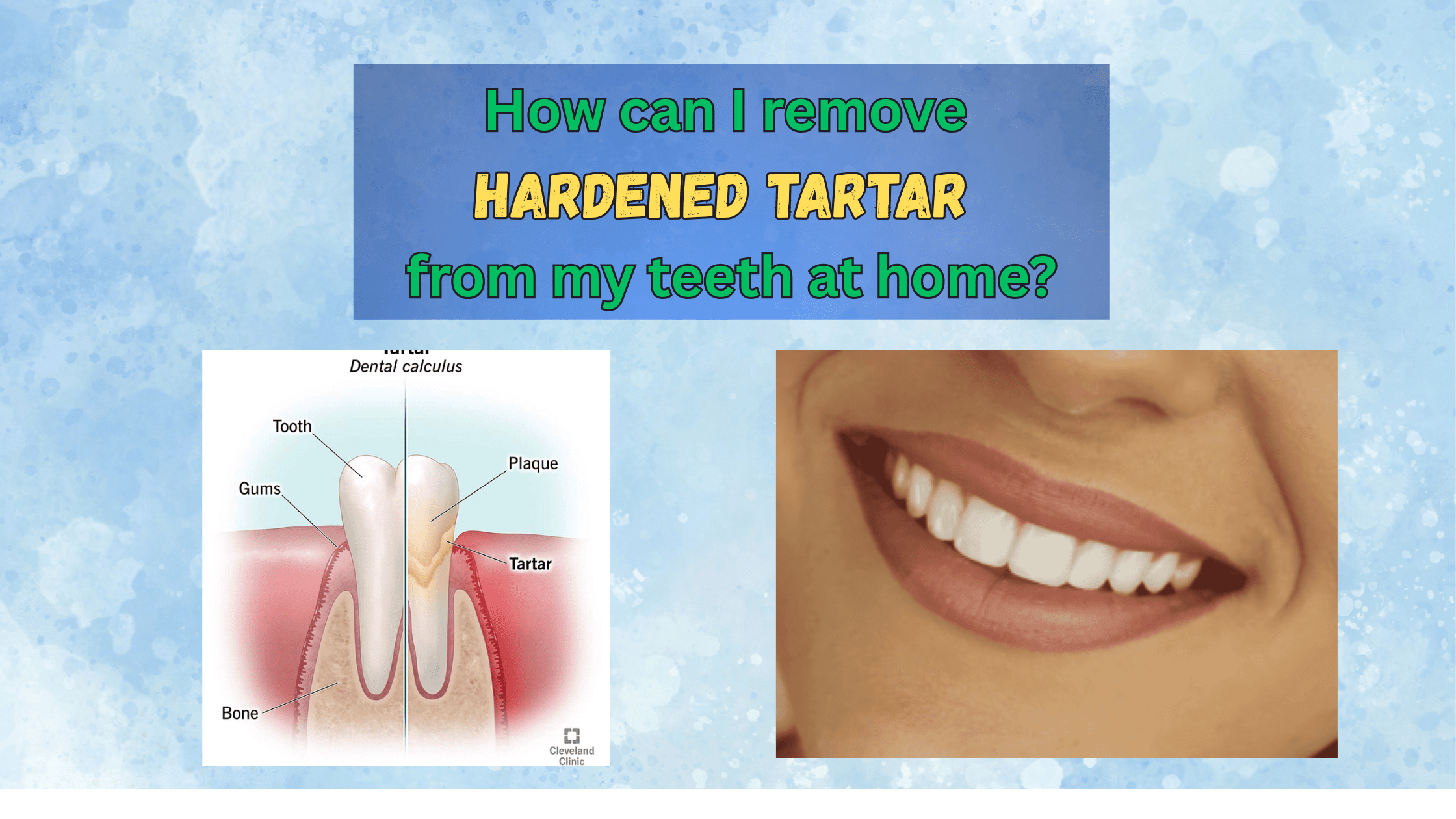 How can I remove hardened tartar from my teeth at home?